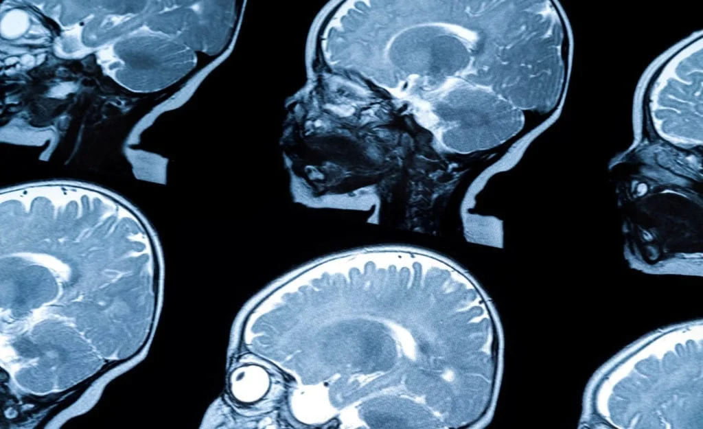 Traumatic Brain Injury