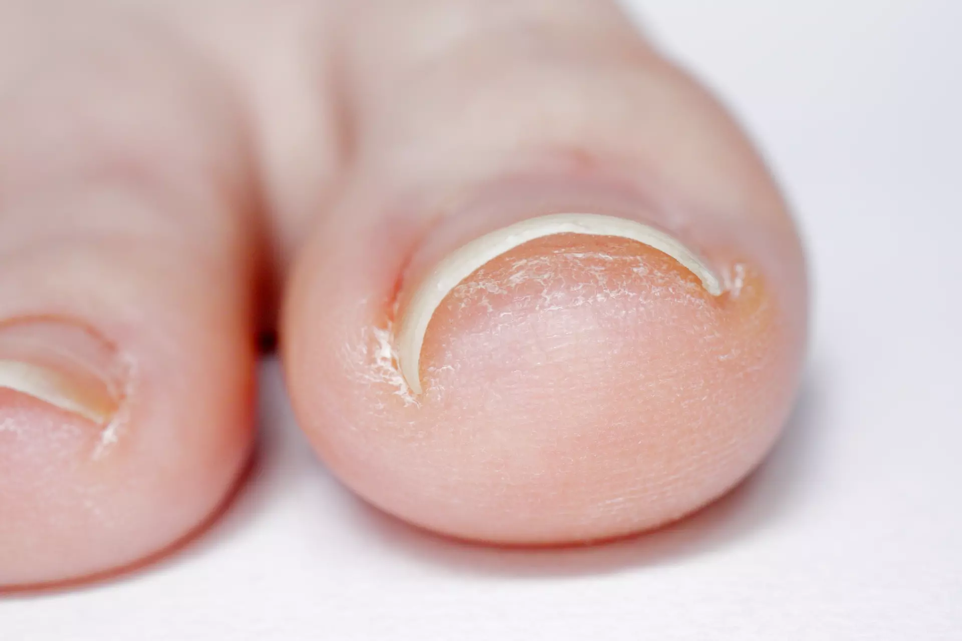 Plantar Fasciitis